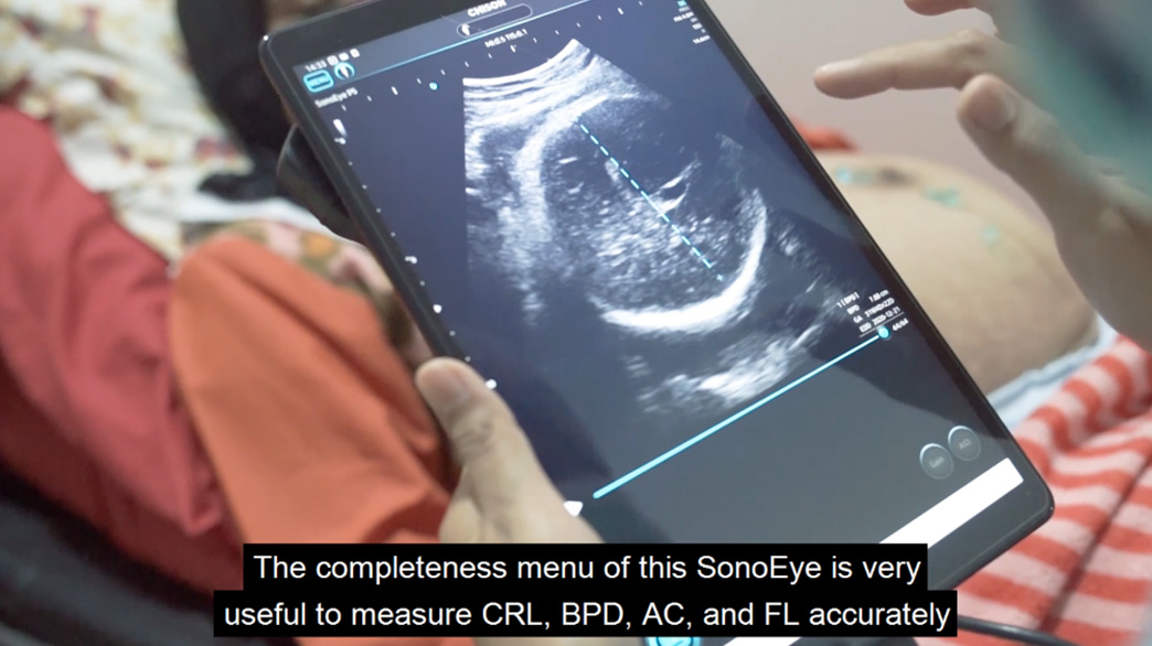 SonoEye 故事 | SonoEye 与印度尼西亚助产士的旅程