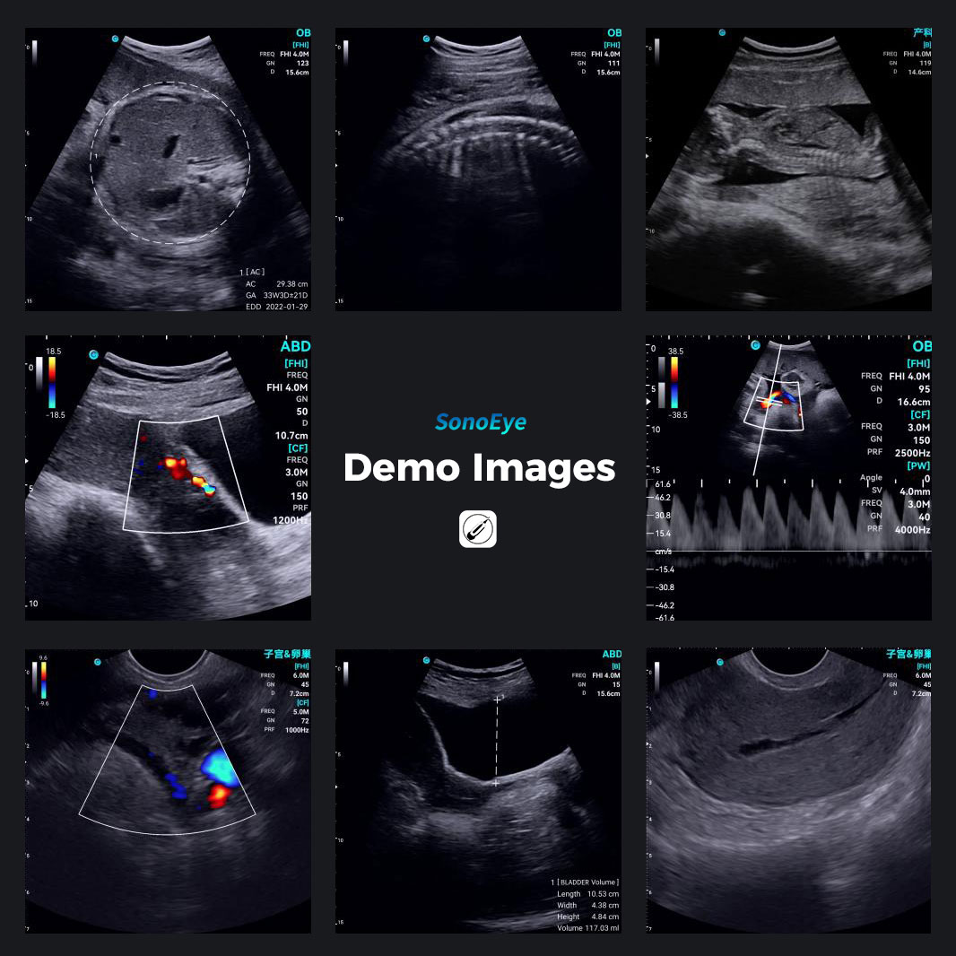 CHISON SonoEye 的愿景是增强女性健康。