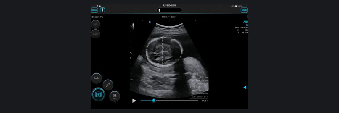 CHISON SonoEye 的愿景是增强女性健康。