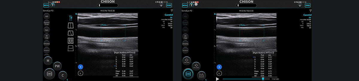 SonoEye 在血管超声中的应用