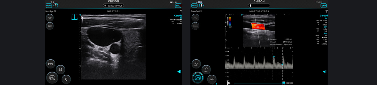 SonoEye 在血管超声中的应用